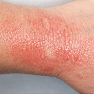 Contact Dermatitis