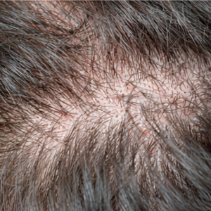 Seborrheic Dermatitis