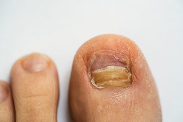 Fungal Infections