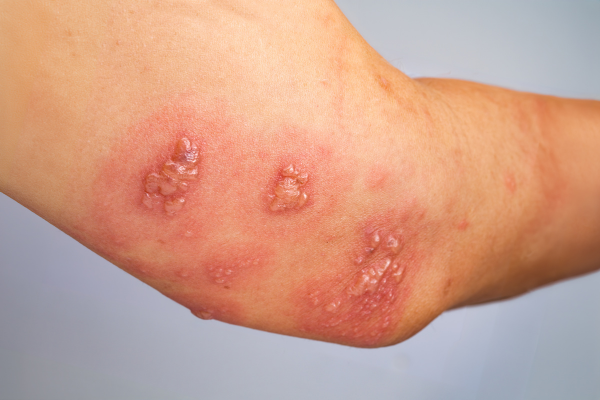 Psoriasis